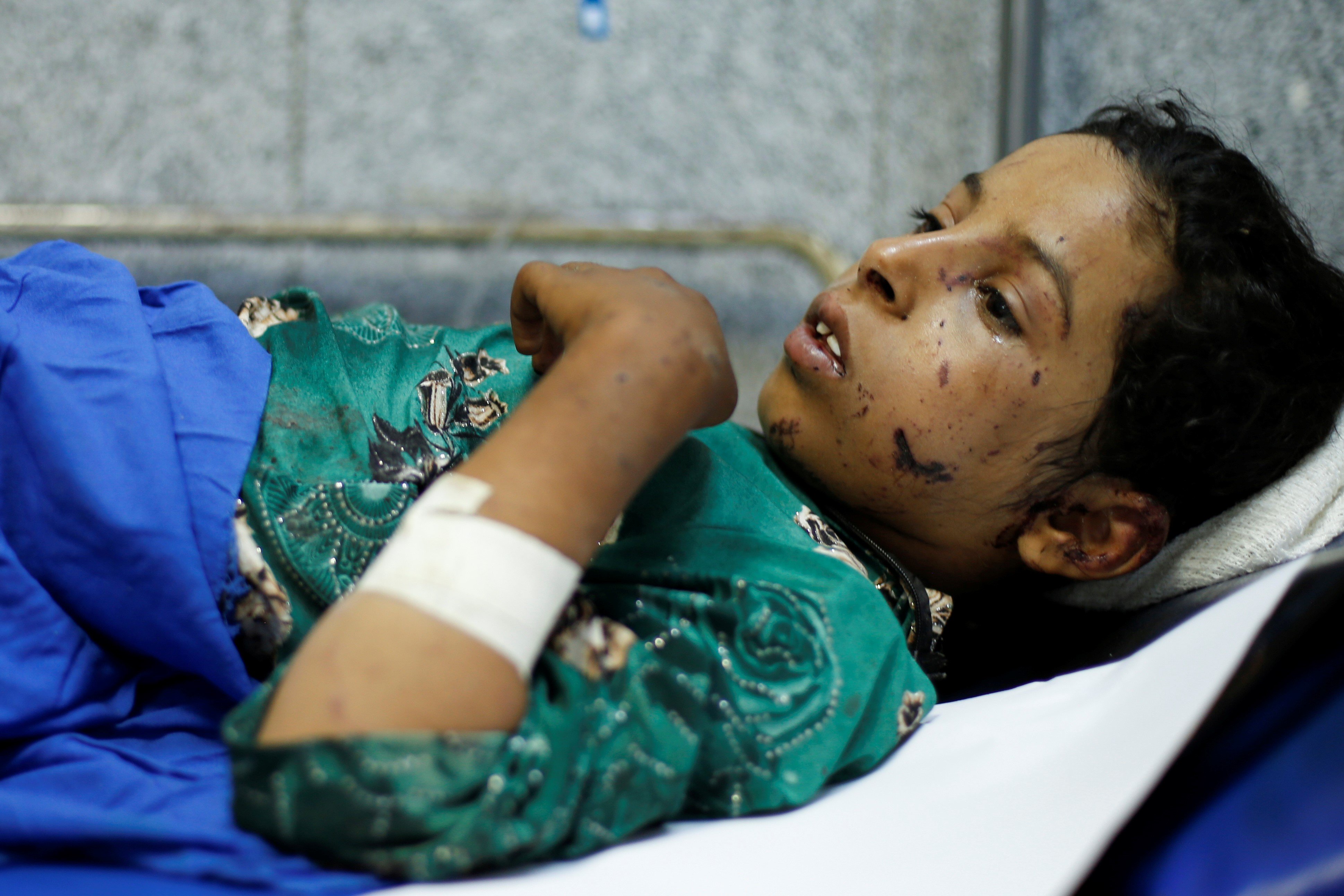 قابول مبخوت في مستشفى صنعاء بعد غارة جوية في محافظة الجوف.