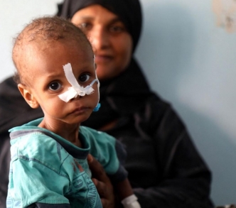 أم تحمل طفلها المصاب بسوء التغذية في منشأة في تعز في اليمن، في 3 تموز/ يوليو 2021.
