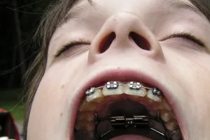 تاريخ تقويم الأسنان: لماذا يضعه الجميع؟